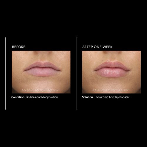 hyaluronic acid lip booster 1